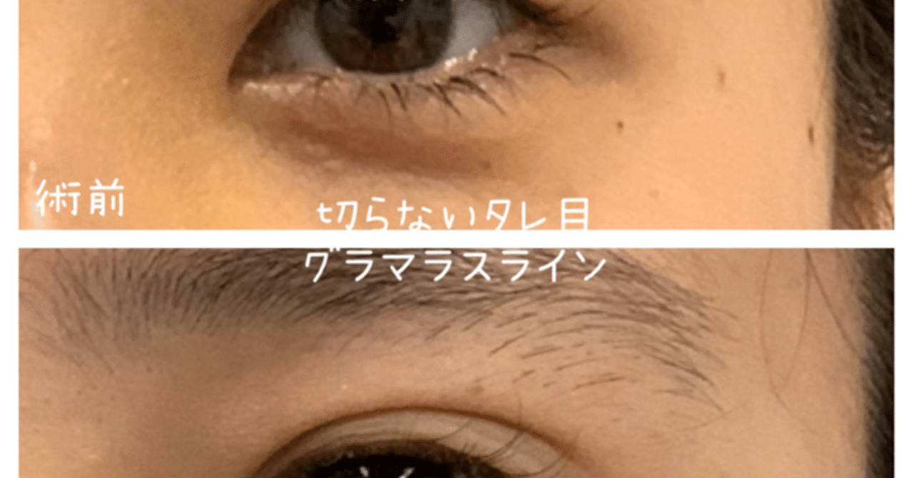 切らないタレ目 グラマラスライン 湘南美容クリニック多田彩子 Note 切らないタレ目 グラマラスライン 湘南美容クリニック多田彩子 Note