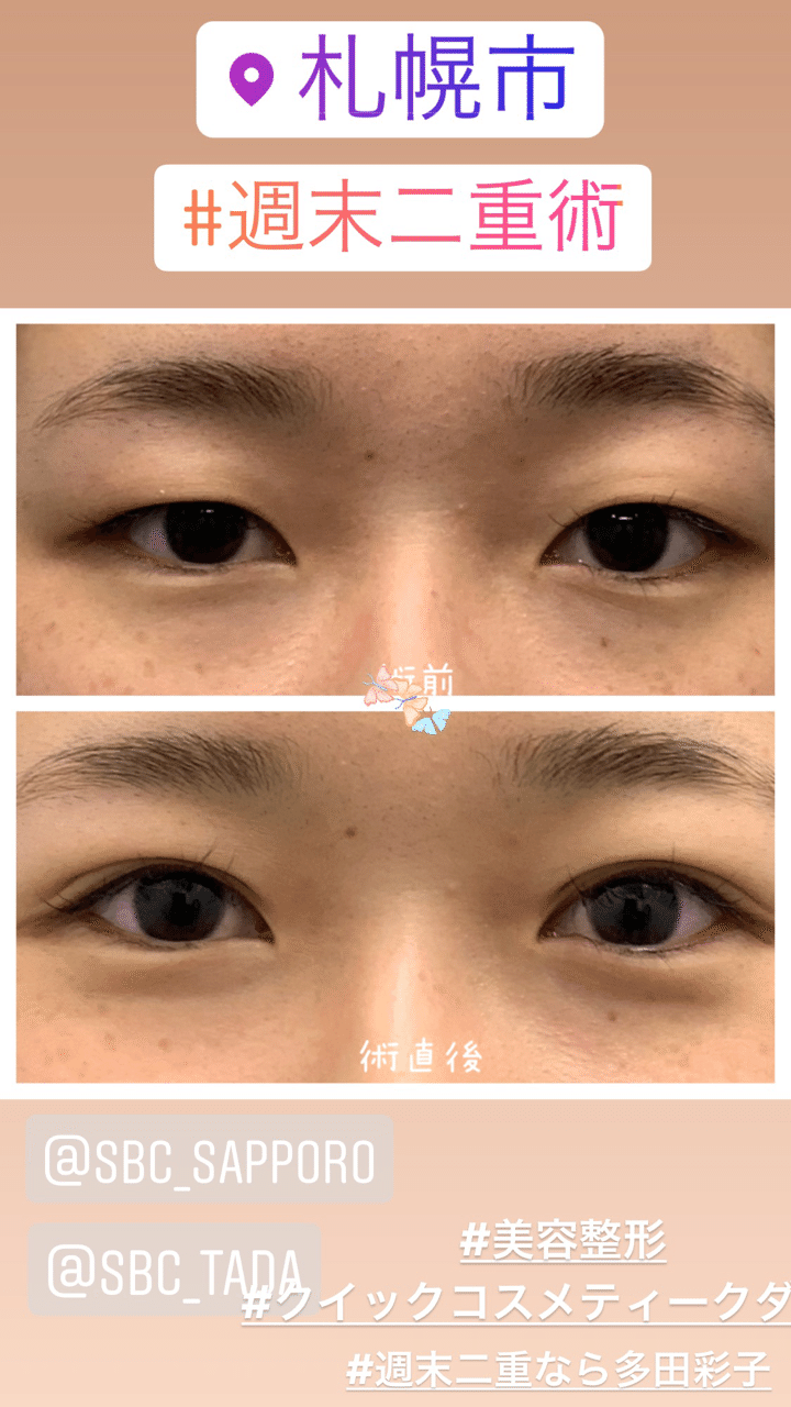 術直後からより可愛い 週末二重術 湘南美容クリニック多田彩子 Note