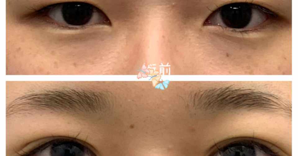 術直後からより可愛い 週末二重術 湘南美容クリニック多田彩子 Note
