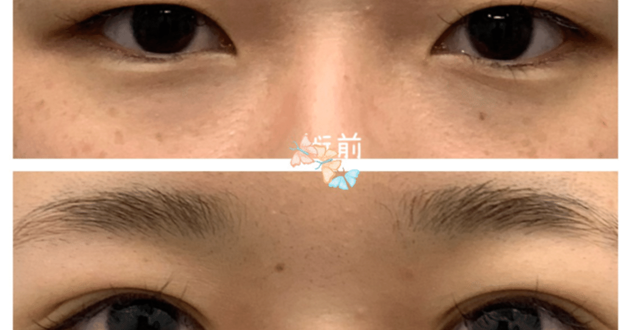 術直後からより可愛い 週末二重術 湘南美容クリニック多田彩子 Note