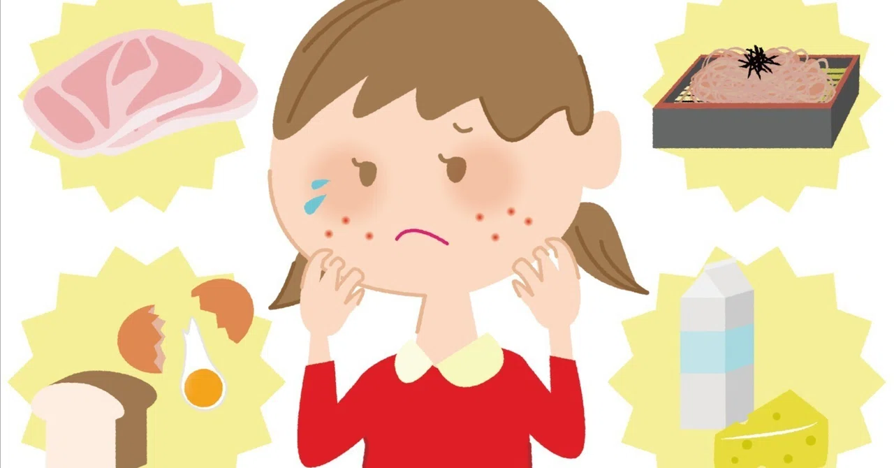[Experience Report] Anaphylaxis that occurred after eating a whole egg ...