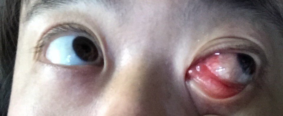 花粉症を忘れて 目に入ったゴミを指で取ろうと頑張ったら あぎ Note 花粉症を忘れて 目に入ったゴミを指で取ろうと頑張ったら あぎ Note