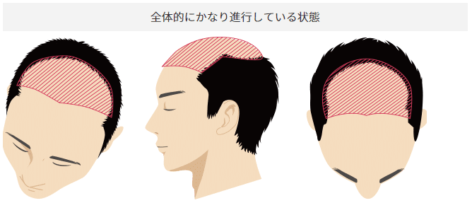 親和クリニック名古屋院 自毛植毛で薄毛が解決する リモート映えも Tatsu Fuyumuro Note