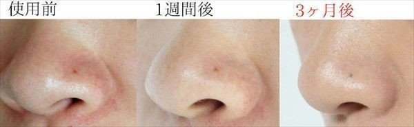 小鼻の赤みの原因とスキンケアでの改善方法 上手な隠し方 まめ Note 小鼻の赤みの原因とスキンケアでの改善方法 上手な隠し方 まめ Note