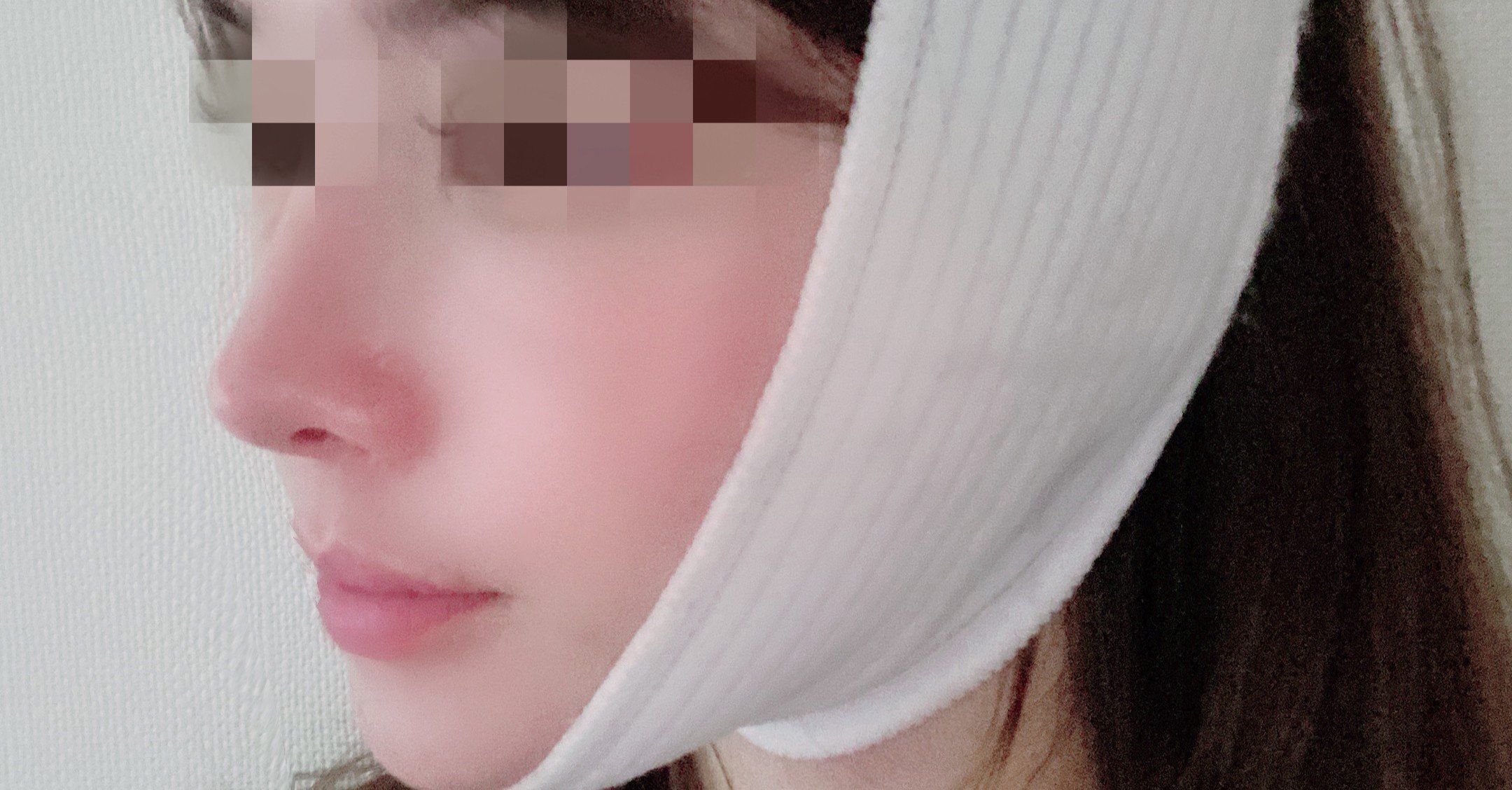 韓国で切開リフトの整形を考えいる方へ 写真付き体験談 病院名公開 みなと Note 韓国で切開リフトの整形を考えいる方へ 写真付き体験談 病院名公開 みなと Note