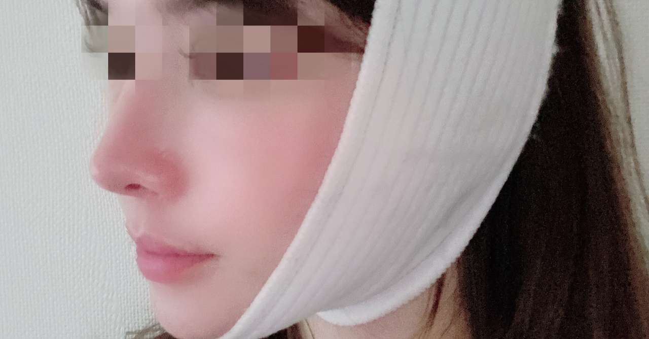 韓国で切開リフトの整形を考えいる方へ 写真付き体験談 病院名公開 みなと Note