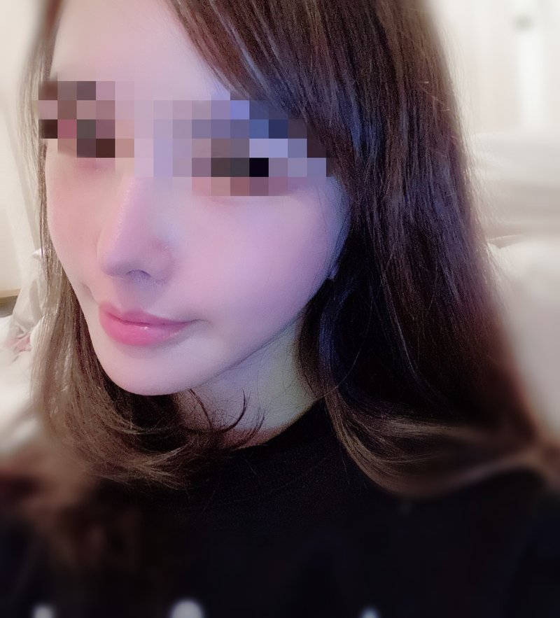 韓国で切開リフトの整形を考えいる方へ 写真付き体験談 病院名公開 みなと Note 韓国で切開リフトの整形を考えいる方へ 写真付き体験談 病院名公開 みなと Note