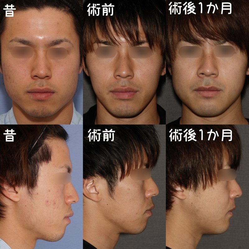 エラの骨切り 両顎手術のリピーター 骨切りドクター宮崎 Note