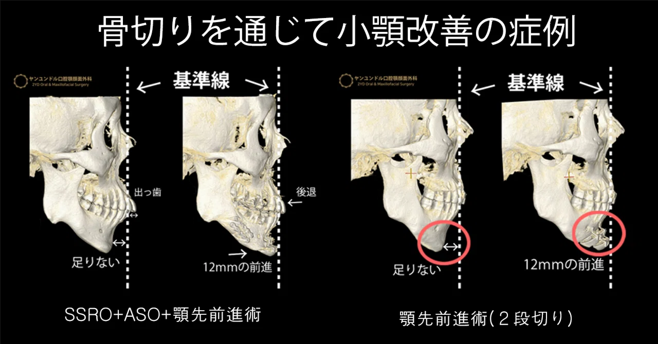ヤンユンドル口腔顎顔面外科」症例で見る小顎症の改善｜ヤンユンドル