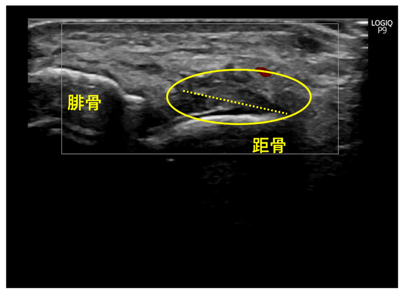 足関節捻挫の疫学と危険因子 Y K Note 足関節捻挫の疫学と危険因子 Y K Note