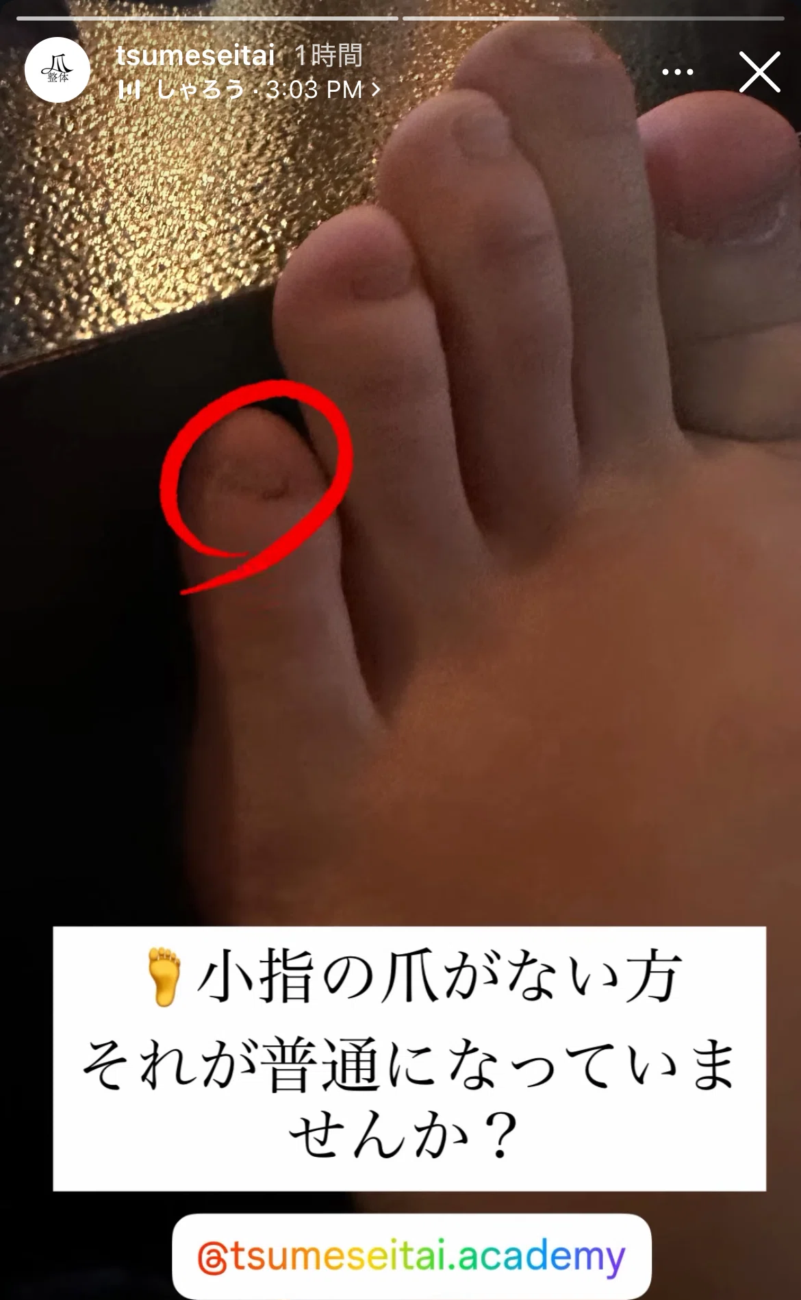 小指 の 爪 が ない