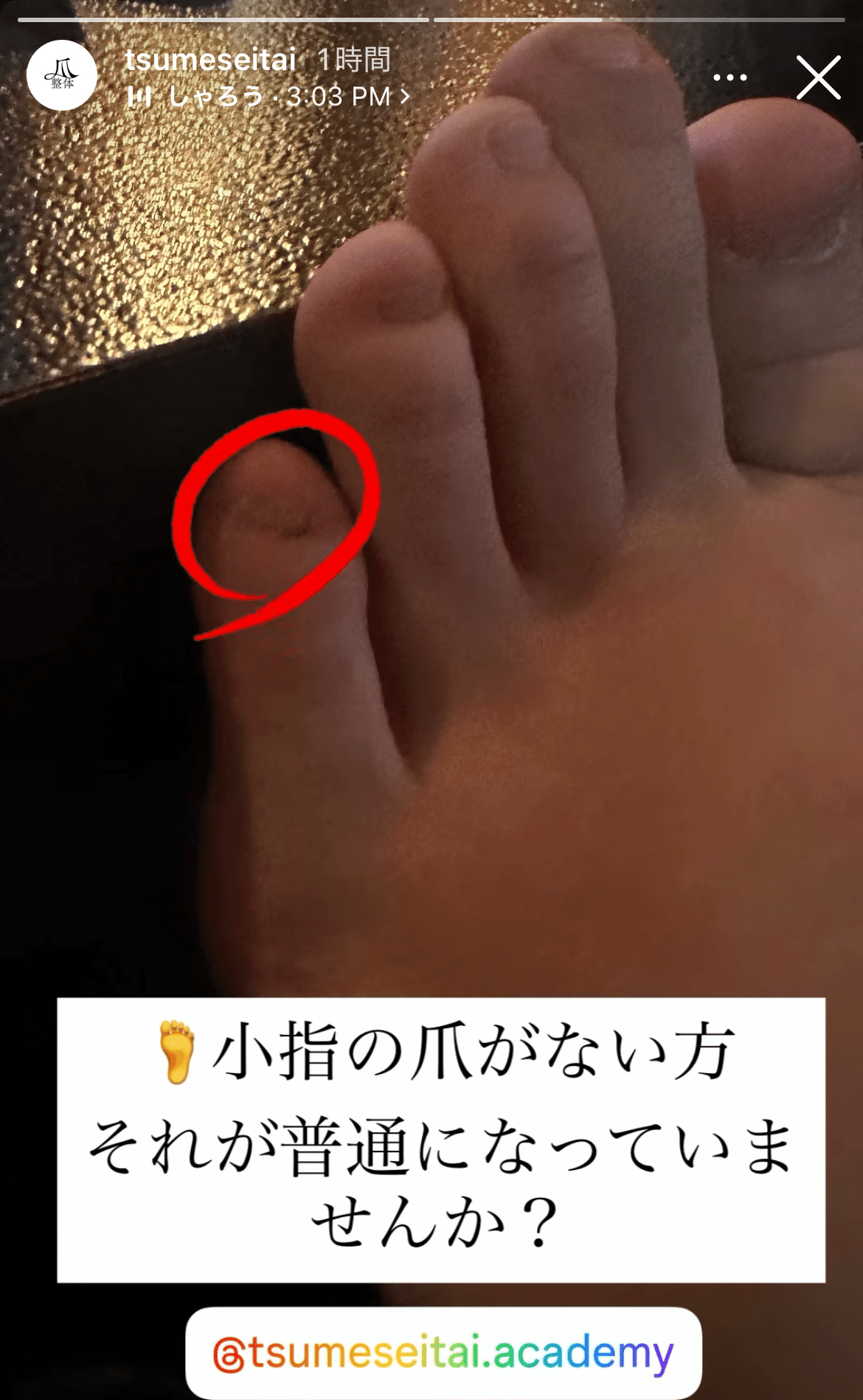 小指の爪がないのは普通？」｜爪整体