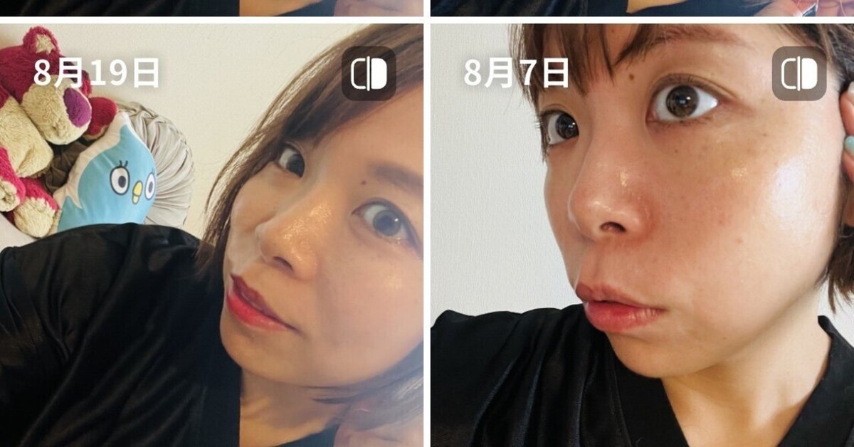メディキューブ　美顔器　【現物の写真追加しました】 ビフォーアフタ「12日間、美顔器ガチで使ってみたら肌が変わった