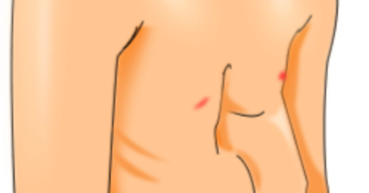 コラム48 胸の形を治したい！漏斗胸（ろうときょう）の話｜佐伯 勇