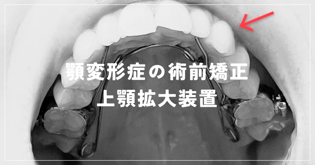 上顎拡大装置のリアル｜歯列矯正3か月目[顎変形症]｜顎なし矯正ちゃん33