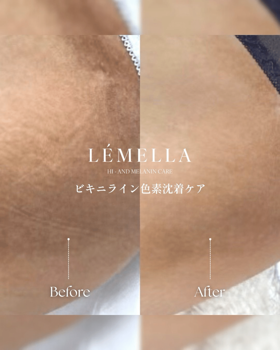 LÉMELLA HIGH-END MELANN CARE ルメラ アフターケア LÉMELLA HIGH-END MELANN CARE ルメラ アフターケア ルメラ（LEMELLA