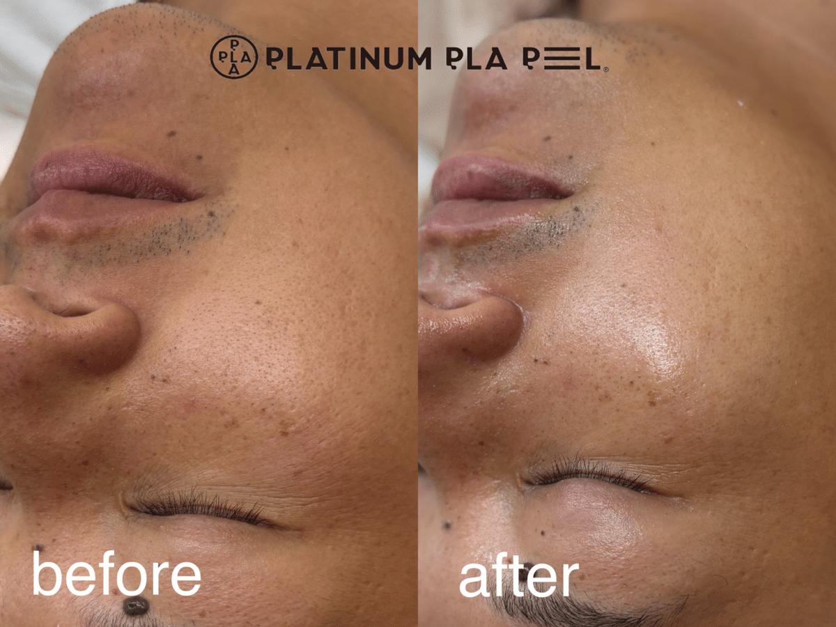 PLATINUM PLA PEEL プラピール　5回分 PLATINUM PLA PEEL プラピール 5回分 - メルカリ