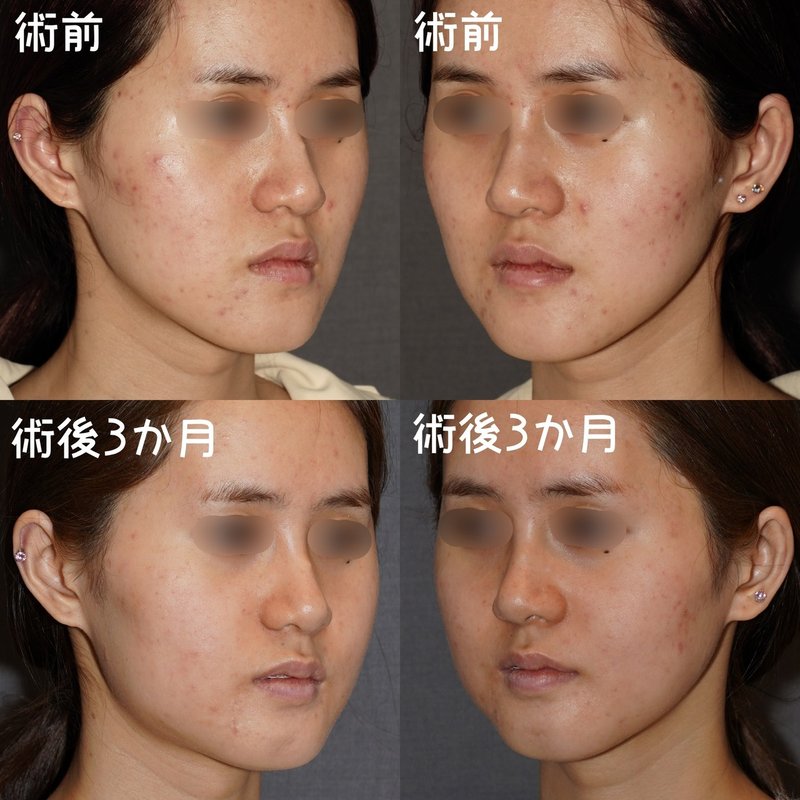 扁平な輪郭に立体感を出す方法 ー両顎手術ー 骨切りドクター宮崎 Note 扁平な輪郭に立体感を出す方法 ー両顎手術ー 骨切りドクター宮崎 Note