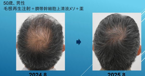 3年連続世界一の育毛剤「ニューモ」使い方ガイド完全版｜らいと
