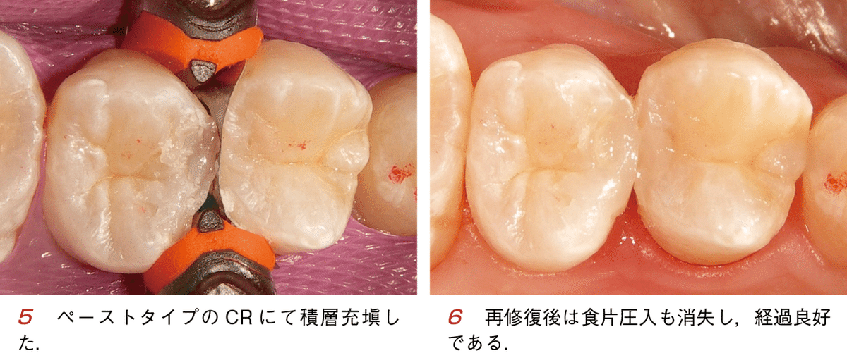 須崎 明・著『そうだったのか！ CR修復』より―やりたくないのに