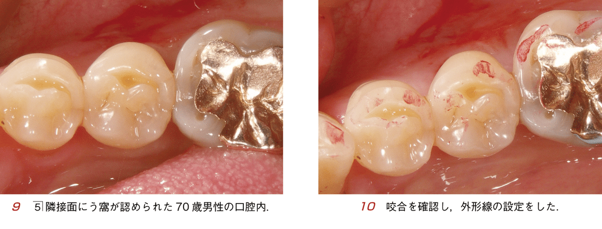 須崎 明・著『そうだったのか！ CR修復』より―やりたくないのに