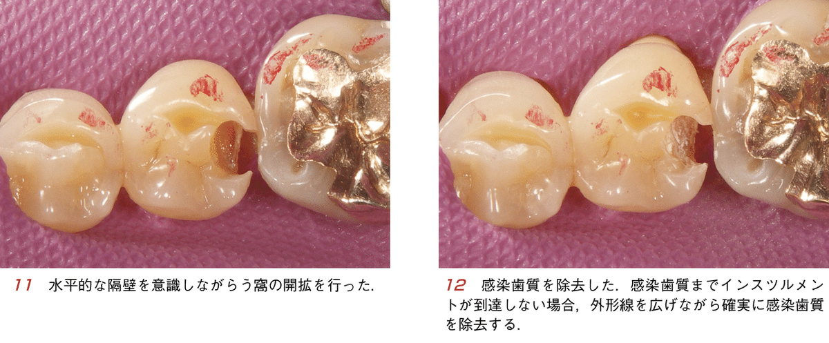 須崎 明・著『そうだったのか！ CR修復』より―やりたくないのに