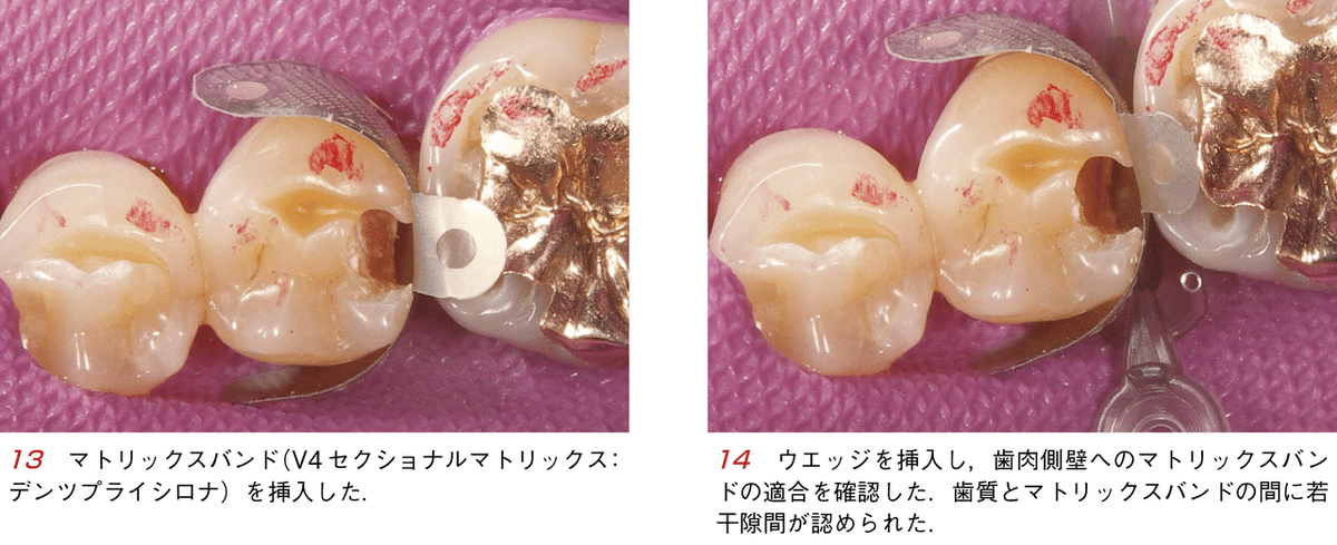 そうだったのか!CR(コンポジットレジン)修復 : CR修復に悩んでいる人に読… Amazon.co.jp: そうだったのか! CR修復―CR修復に悩んでいる人に
