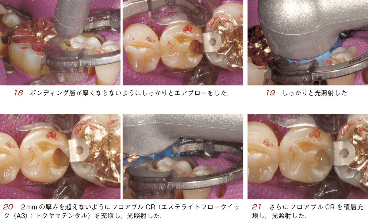 そうだったのか!CR(コンポジットレジン)修復 : CR修復に悩んでいる人に読… Amazon.co.jp: そうだったのか! CR修復―CR修復に悩んでいる人に