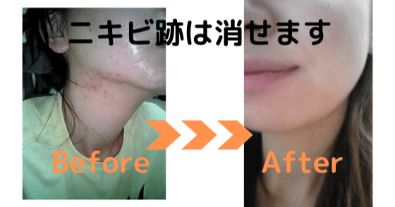 ニキビ跡は消せます 10年間マスク生活だった私が たったの28日でニキビ跡を消した方法 Maria Note