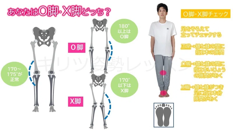 3つの部位からしっかり治す！О脚改善のススメ～膝上O脚ver～｜理学療法士キリツ＠姿勢コントロール