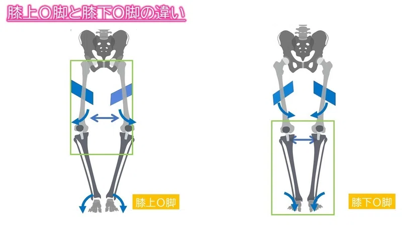 3つの部位からしっかり治す！О脚改善のススメ～膝上O脚ver～｜理学療法士キリツ＠姿勢コントロール