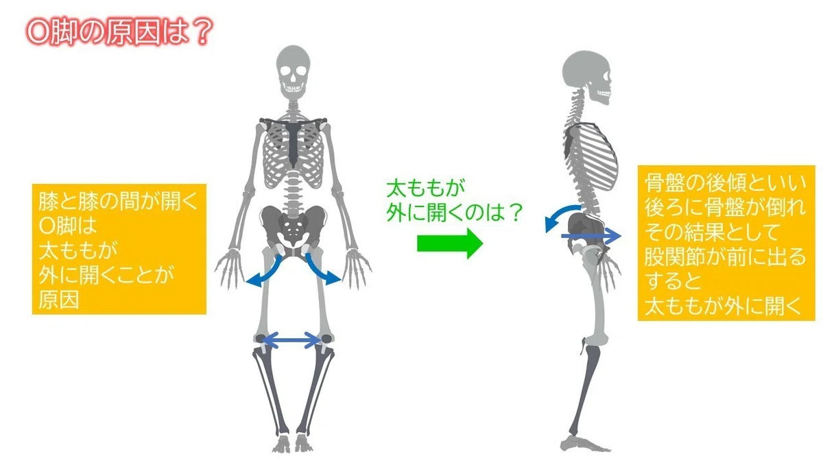 3つの部位からしっかり治す！О脚改善のススメ～膝上O脚ver～｜理学療法士キリツ＠姿勢コントロール