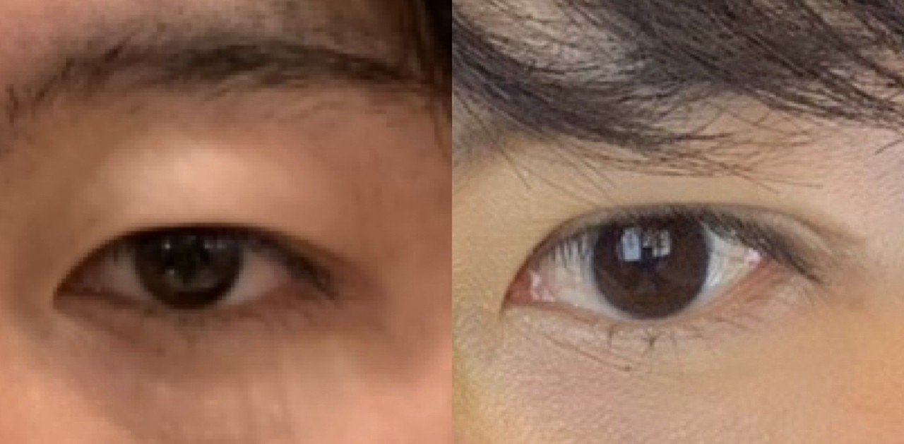 25歳男で二重に整形した体験談 西村マサヤ Note