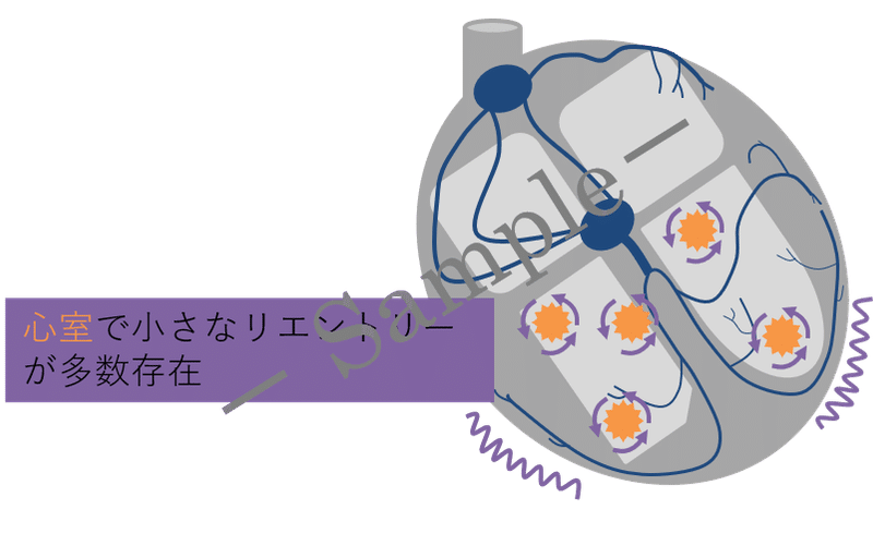 心電図イラスト 心室細動 Vf Ceme Jpeg Note 心電図イラスト 心室細動 Vf Ceme Jpeg Note