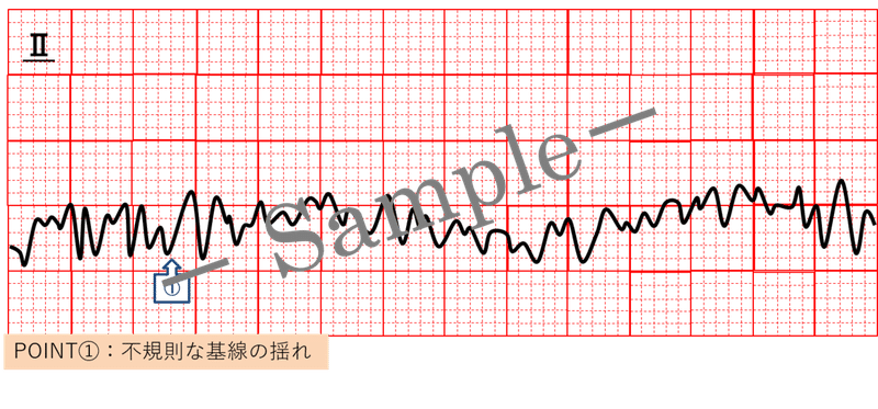 心電図イラスト 心室細動 Vf Ceme Jpeg Note 心電図イラスト 心室細動 Vf Ceme Jpeg Note