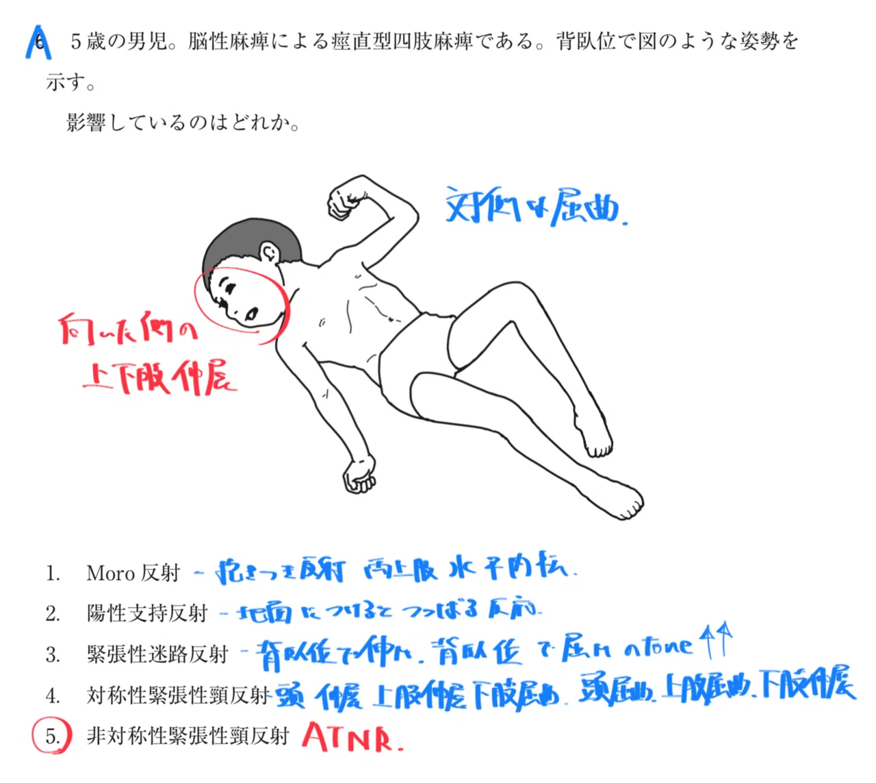 緊張 性 迷路 反射