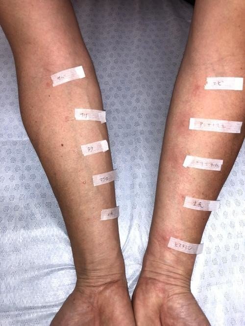 アニサキス アレルギーかも と思ったら Ige抗体検査とプリックテスト さとなお 佐藤尚之 Note