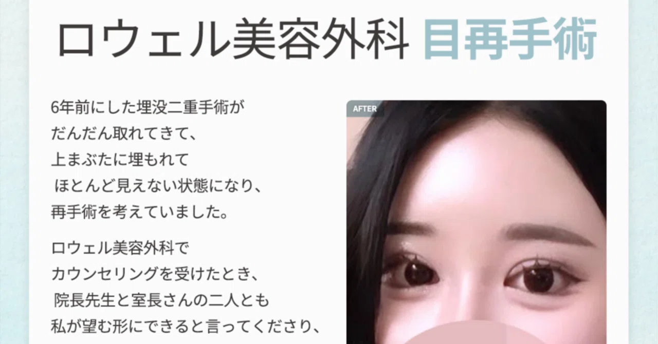[BF-AF] Achieving a clear double eyelid line & beautiful, symmetrical ...