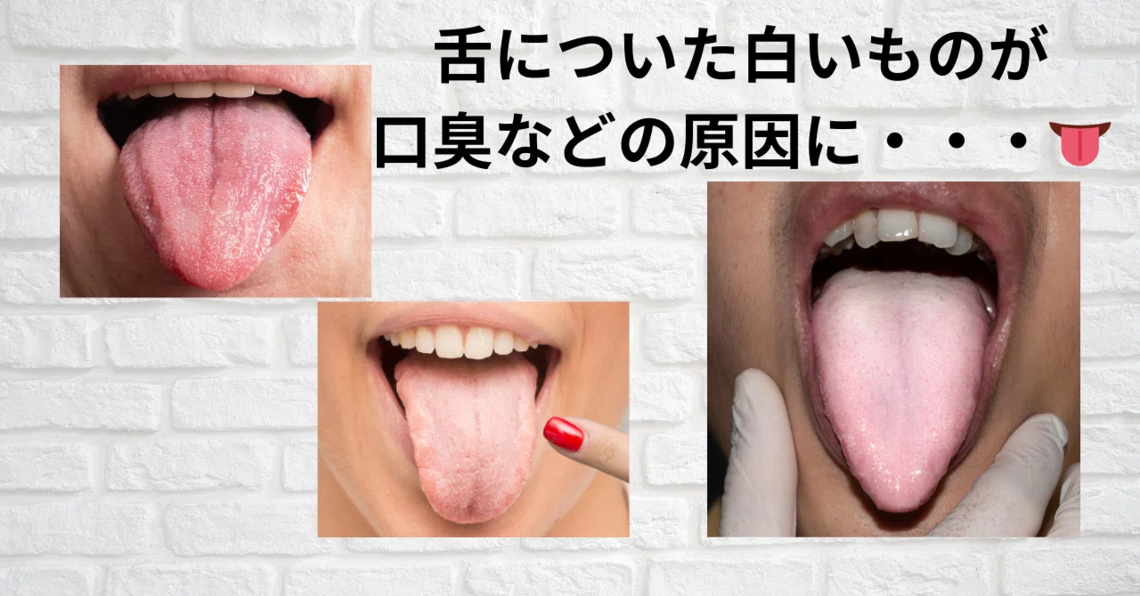 舌についた白いものが口臭などの原因に・・・👅｜いずみ中山歯科