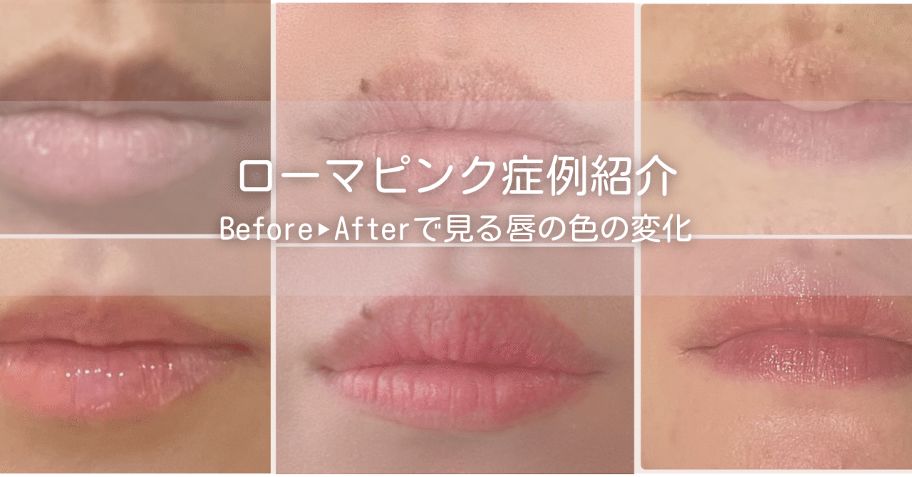 青森市】ローマピンク症例紹介｜リップの黒ずみ・色素沈着ケア｜ルタン