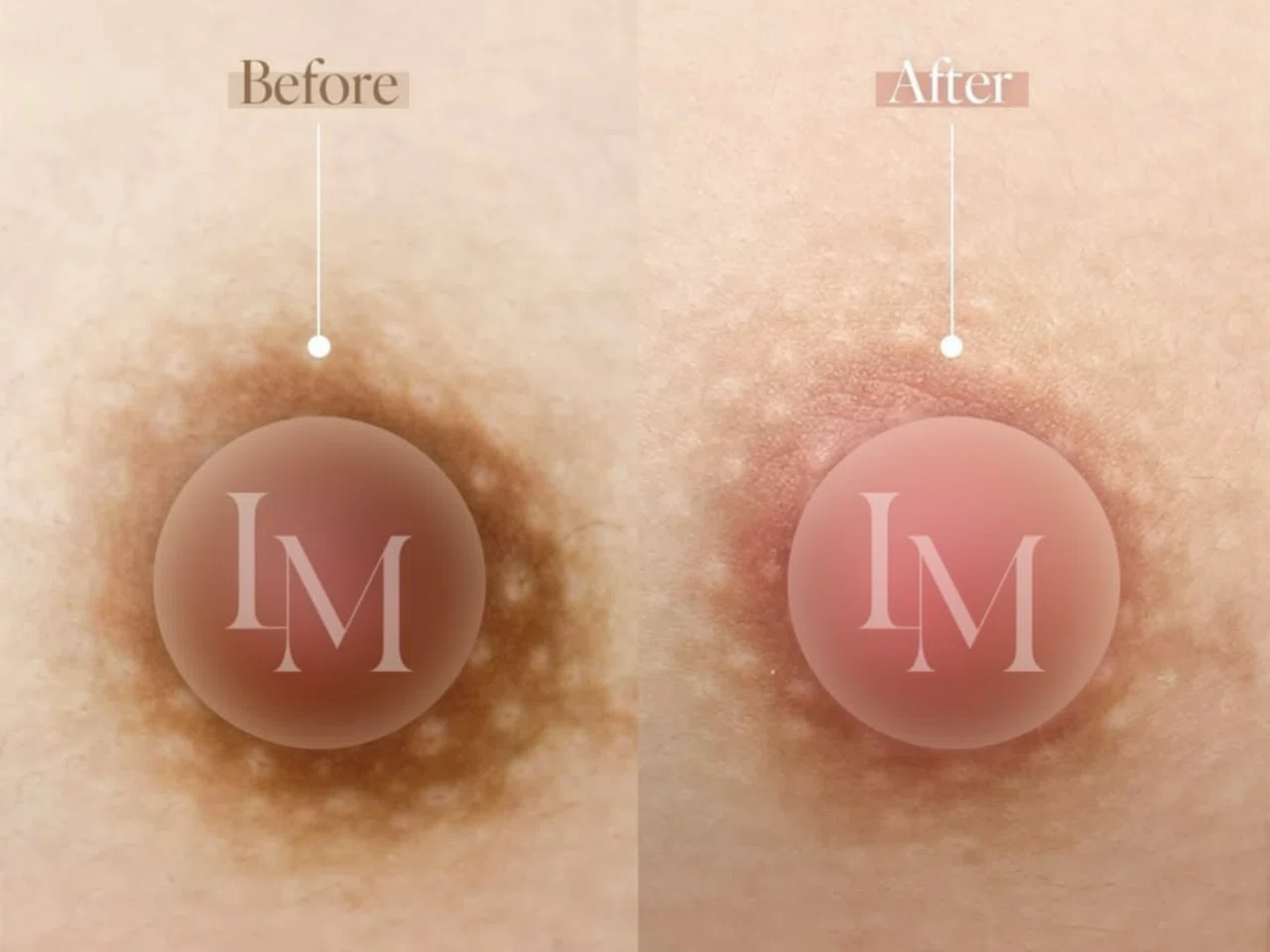 Micropigmentación de pezón y areola