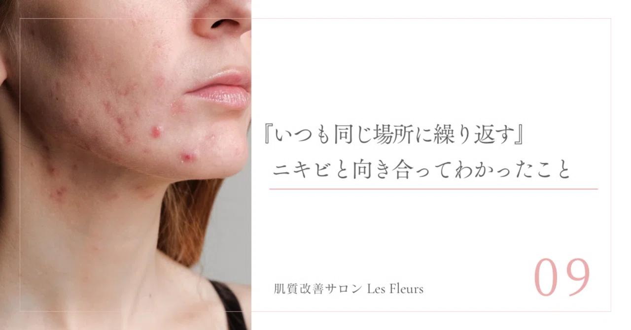 繰り返す ニキビ 同じ 場所