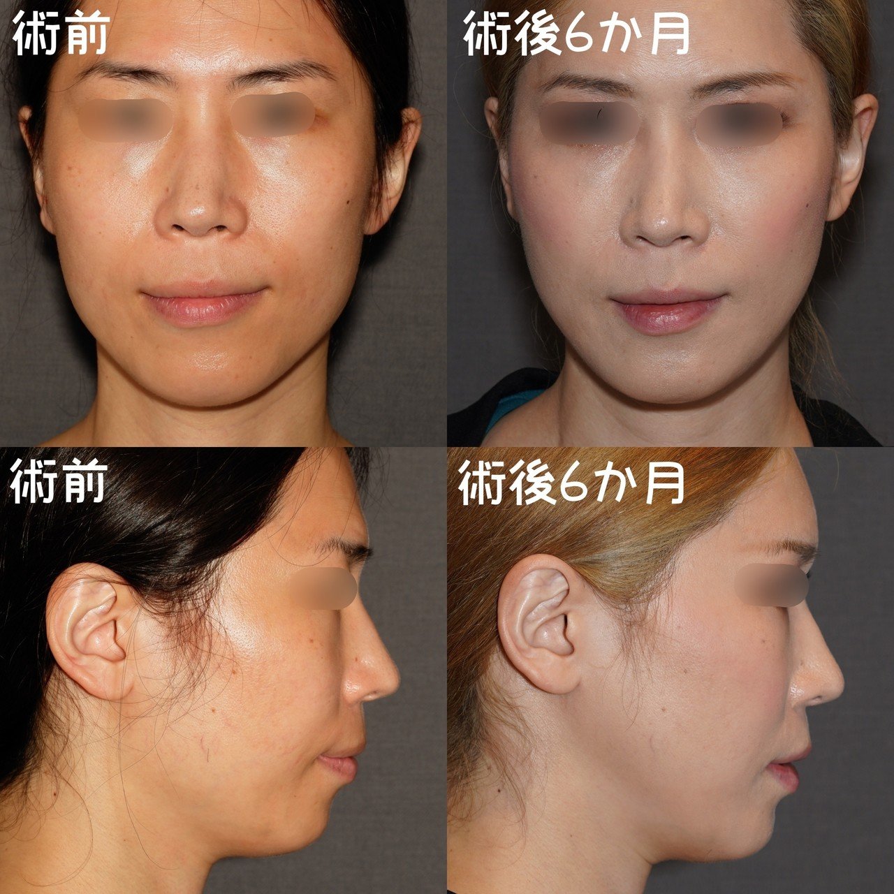 シャープなvライン 小顔の作り方 骨切りドクター宮崎 Note