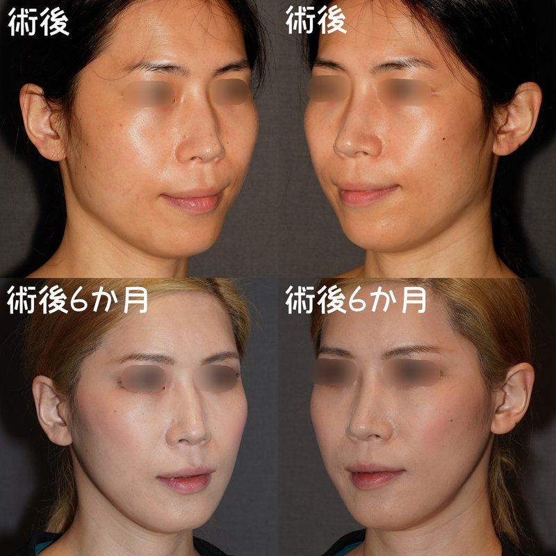 シャープなvライン 小顔の作り方 骨切りドクター宮崎 Note