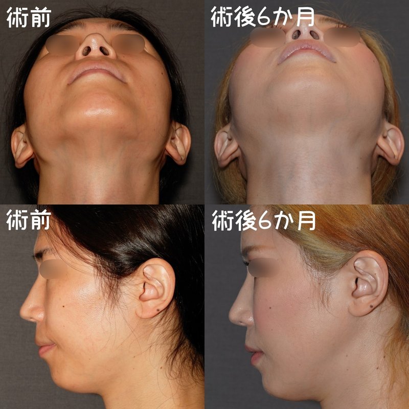 シャープなvライン 小顔の作り方 骨切りドクター宮崎 Note