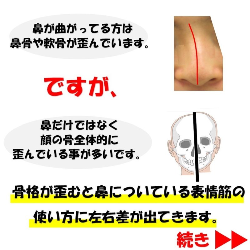 鼻が曲がって小鼻の広がりに左右差がある時の矯正法5選 Revisionginza Note 鼻が曲がって小鼻の広がりに左右差がある時の矯正法5選 Revisionginza Note