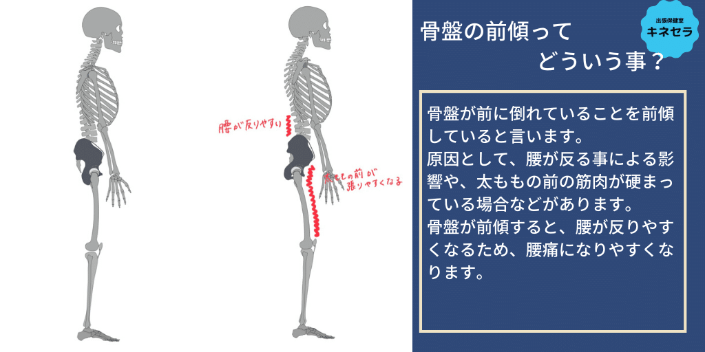 骨盤の傾きの説明画像 キネセラ 姿勢改善 骨盤 背骨 エステ ストレッチ マッサージ Note