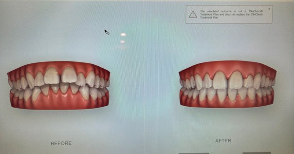 おうち矯正 0歳からのおうち矯正 | oralsmile