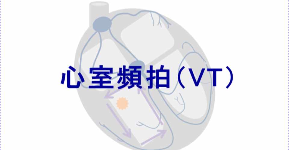 心電図イラスト 心室頻拍 Vt Ceme Jpeg Note