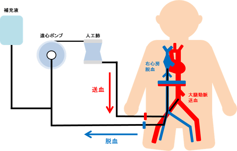 新型コロナウィルスウィルスへの治療方法 Ecmo エクモ を知ろう Ceme Jpeg Note 新型コロナウィルスウィルスへの治療方法 Ecmo エクモ を知ろう Ceme Jpeg Note